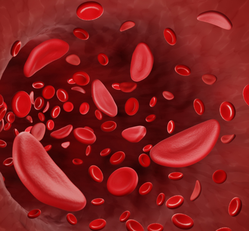 sickil Cell Anemia